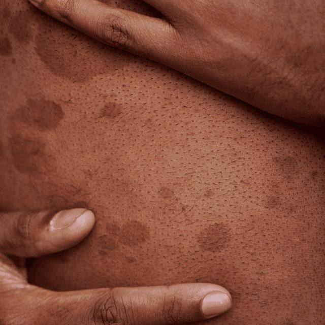 Butt Facial at Mne Aesthetics in Missouri City, TX