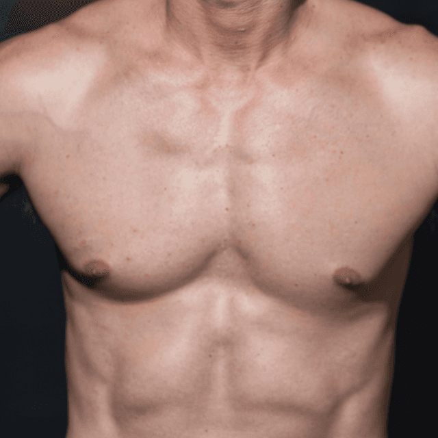 Full Chest Body Reset (3) at Mne Aesthetics in Missouri City, TX